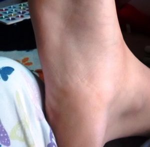 Painful heel